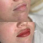 What Heals Lips Fastest Overnight?