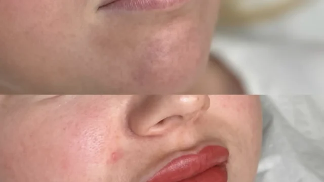 What Heals Lips Fastest Overnight?
